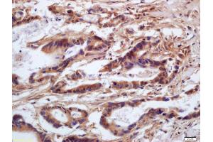 Formalin-fixed and paraffin embedded human gastric carcinoma labeled with Anti-phospho-MLC(Ser20) /Myosin light chain(Ser20) Polyclonal Antibody, Unconjugated (ABIN872283) at 1:200 followed by conjugation to the secondary antibody and DAB staining