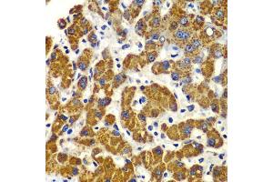 Immunohistochemistry of paraffin-embedded human liver injury using SMAD9 antibody (ABIN5975592) at dilution of 1/100 (40x lens). (SMAD9 anticorps)