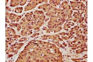 IHC image of ABIN7153389 diluted at 1:225 and staining in paraffin-embedded human pancreatic cancer performed on a Leica BondTM system.