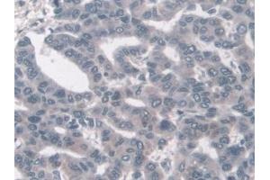 Detection of KLC1 in Human Liver cancer Tissue using Polyclonal Antibody to Kinesin Light Chain 1 (KLC1)