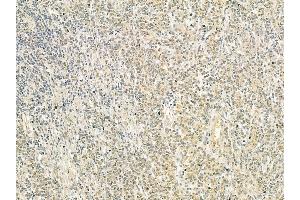 PPP1R7 Mouse Monoclonal Antibody at 1/100 staining human gastric cancer by IHC-P.