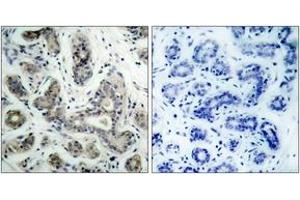 Immunohistochemistry analysis of paraffin-embedded human breast carcinoma tissue, using PDK1 (Ab-241) Antibody. (PDPK1 anticorps  (AA 210-259))