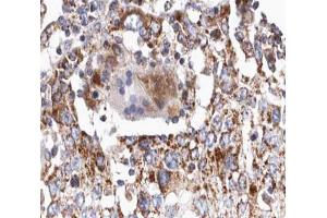 ABIN6266641 at 1/100 staining human lung carcinoma tissue sections by IHC-P. (TGFB2 anticorps  (C-Term))
