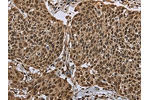 The image on the left is immunohistochemistry of paraffin-embedded Human cervical cancer tissue using ABIN7130674(PPAT Antibody) at dilution 1/50, on the right is treated with fusion protein. (PPAT anticorps)