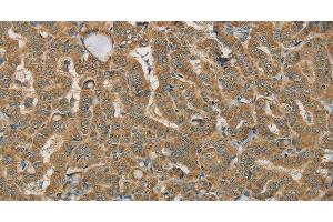 Immunohistochemistry of paraffin-embedded Human thyroid cancer using SDHB Polyclonal Antibody at dilution of 1:30