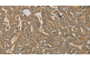 Immunohistochemistry of paraffin-embedded Human thyroid cancer using SDHB Polyclonal Antibody at dilution of 1:30 (SDHB anticorps)