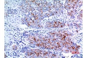 Immunohistochemistry (IHC) analysis of paraffin-embedded Human Mammary Cancer, antibody was diluted at 1:100.