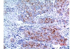 Immunohistochemistry (IHC) analysis of paraffin-embedded Human Mammary Cancer, antibody was diluted at 1:100. (pan Keratin anticorps  (pan))