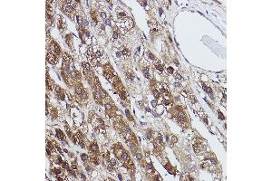 Immunohistochemistry of paraffin-embedded human liver cancer using FBP1 Rabbit mAb (ABIN7267269) at dilution of 1:100 (40x lens). (FBP1 anticorps)