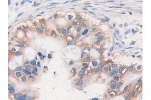 Detection of MVP in Human Bile duct cancer Tissue using Polyclonal Antibody to Major Vault Protein (MVP)