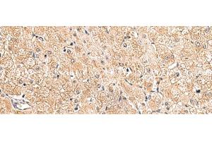 Immunohistochemistry of paraffin-embedded Human liver cancer tissue using LRG1 Polyclonal Antibody at dilution of 1:80(x200)