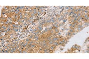 Immunohistochemistry of paraffin-embedded Human breast cancer using STX16 Polyclonal Antibody at dilution of 1:30 (Syntaxin 16 anticorps)