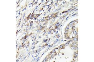 Immunohistochemistry of paraffin-embedded human lung cancer using IL1A Rabbit pAb (ABIN6129280, ABIN6142331, ABIN6142332 and ABIN6217051) at dilution of 1:100 (40x lens). (IL1A anticorps  (AA 112-271))