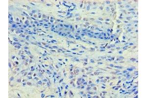 Immunohistochemistry of paraffin-embedded human breast cancer using ABIN7155327 at dilution of 1:100 (HDAC8 anticorps  (AA 1-377))