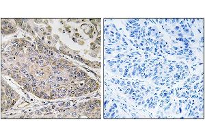 Immunohistochemistry analysis of paraffin-embedded human lung carcinoma tissue using PLA2G4E antibody. (PLA2G4E anticorps)