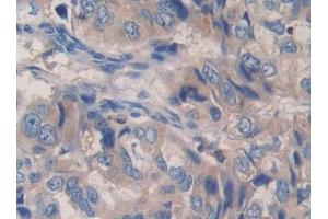 Used in DAB staining on fromalin fixed paraffin- embedded liver cancer tissue (PCSK9 anticorps  (AA 454-679))