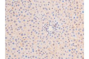 ABIN6267289 at 1/100 staining rat liver cancer tissue sections by IHC-P.