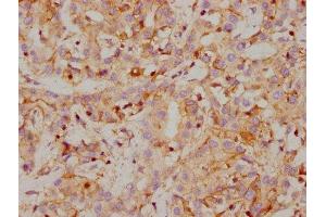 IHC image of ABIN7127380 diluted at 1:118 and staining in paraffin-embedded human liver cancer performed on a Leica BondTM system. (Recombinant CA9 anticorps)
