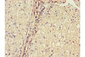 Immunohistochemistry of paraffin-embedded human liver cancer using ABIN7159937 at dilution of 1:100 (BRP44 anticorps  (AA 1-40))