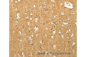 Immunohistochemistry of Human liver cancer using LPAR3 Polyclonal Antibody at dilution of 1:40 (LPAR3 anticorps)