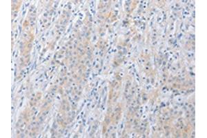 The image on the left is immunohistochemistry of paraffin-embedded Human gastric cancer tissue using ABIN7131038(SERPINE2 Antibody) at dilution 1/20, on the right is treated with fusion protein.
