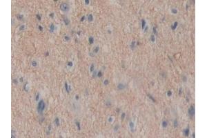 Detection of ENPEP in Human Glioma Tissue using Polyclonal Antibody to Aminopeptidase A (ENPEP) (ENPEP anticorps  (AA 718-948))