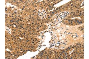 The image on the left is immunohistochemistry of paraffin-embedded Human breast cancer tissue using ABIN7191443(MED14 Antibody) at dilution 1/20, on the right is treated with synthetic peptide. (MED14 anticorps)
