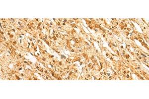 Immunohistochemistry of paraffin-embedded Human prost ate cancer tissue using SSSCA1 Polyclonal Antibody at dilution of 1:50(x200) (SSSCA1 anticorps)