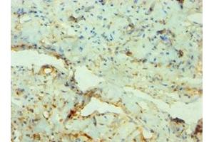 Immunohistochemistry of paraffin-embedded human cervical cancer using ABIN7169180 at dilution of 1:100