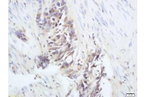 Formalin-fixed and paraffin embedded human colon cancer labeled with Anti-phospho-RAC1(Ser71) Polyclonal Antibody, Unconjugated  at 1:200 followed by conjugation to the secondary antibody and DAB staining