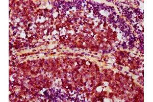 IHC image of ABIN7127677 diluted at 1:100 and staining in paraffin-embedded human lung cancer performed on a Leica BondTM system. (Recombinant AKT1 anticorps  (pSer473))