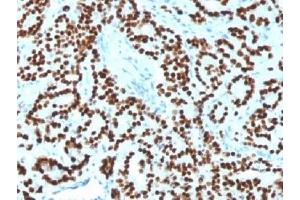 IHC testing of FFPE human prostate carcinoma with FOXA1 antibody (clone FOXA1/1518). (FOXA1 anticorps  (AA 372-472))