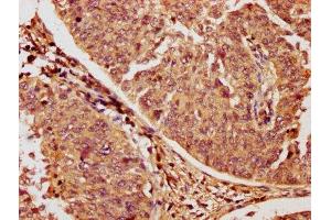 IHC image of ABIN7167196 diluted at 1:1200 and staining in paraffin-embedded human cervical cancer performed on a Leica BondTM system.