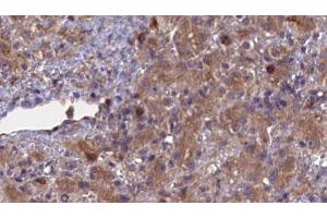 ABIN6276936 at 1/100 staining Human liver cancer tissue by IHC-P.