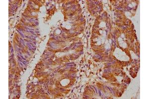 IHC image of ABIN7164832 diluted at 1:500 and staining in paraffin-embedded human colon cancer performed on a Leica BondTM system.