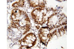 Anti-FOXP1 antibody, IHC(P) IHC(P): Human Rectal Cancer Tissue (FOXP1 anticorps  (C-Term))