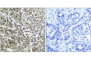 Immunohistochemistry analysis of paraffin-embedded human prostate carcinoma tissue, using Androgen Receptor (Ab-650) Antibody. (Androgen Receptor anticorps  (AA 621-670))