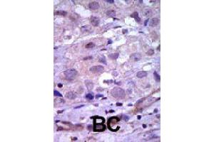 Formalin-fixed and paraffin-embedded human cancer tissue reacted with RET polyclonal antibody  , which was peroxidase-conjugated to the secondary antibody, followed by AEC staining. (Ret Proto-Oncogene anticorps  (N-Term))