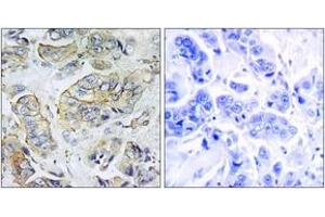 Immunohistochemistry analysis of paraffin-embedded human breast carcinoma tissue, using NPY5R Antibody. (NPY5R anticorps  (AA 221-270))