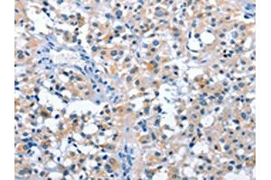 The image on the left is immunohistochemistry of paraffin-embedded Human thyroid cancer tissue using ABIN7128547(ASB2 Antibody) at dilution 1/50, on the right is treated with fusion protein. (ASB2 anticorps)