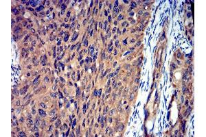 Immunohistochemical analysis of paraffin-embedded ROP1 tissues using cervical cancer mouse mAb with DAB staining. (ROP1 (AA 42-183) anticorps)