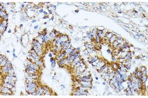Immunohistochemistry of paraffin-embedded Human colon carcinoma using TRAP1 Polyclonal Antibody at dilution of 1:100 (40x lens).