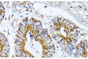 Immunohistochemistry of paraffin-embedded Human colon carcinoma using TRAP1 Polyclonal Antibody at dilution of 1:100 (40x lens). (TRAP1 anticorps)