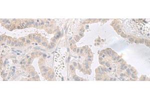 Immunohistochemistry of paraffin-embedded Human thyroid cancer tissue using GPRASP2 Polyclonal Antibody at dilution of 1:35(x200) (GPRASP2 anticorps)
