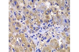 Immunohistochemistry of paraffin-embedded Human liver damage using CARD10 Polyclonal Antibody at dilution of 1:100 (40x lens). (CARD10 anticorps)