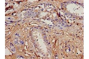 Immunohistochemistry analysis of human breast cancer using ABIN7164734 at dilution of 1:100 (PIP anticorps  (AA 29-146))