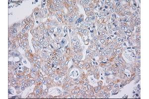 Immunohistochemical staining of paraffin-embedded Carcinoma of liver tissue using anti-KRT19mouse monoclonal antibody. (Cytokeratin 19 anticorps  (AA 240-390))