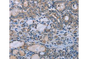 Immunohistochemistry of Human thyroid cancer using HOMER1 Polyclonal Antibody at dilution of 1:50 (HOMER1 anticorps)