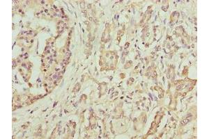 Immunohistochemistry of paraffin-embedded human pancreatic cancer using ABIN7145484 at dilution of 1:100