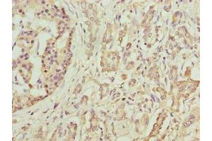 Immunohistochemistry of paraffin-embedded human pancreatic cancer using ABIN7145484 at dilution of 1:100 (DEFB129 anticorps  (AA 20-183))